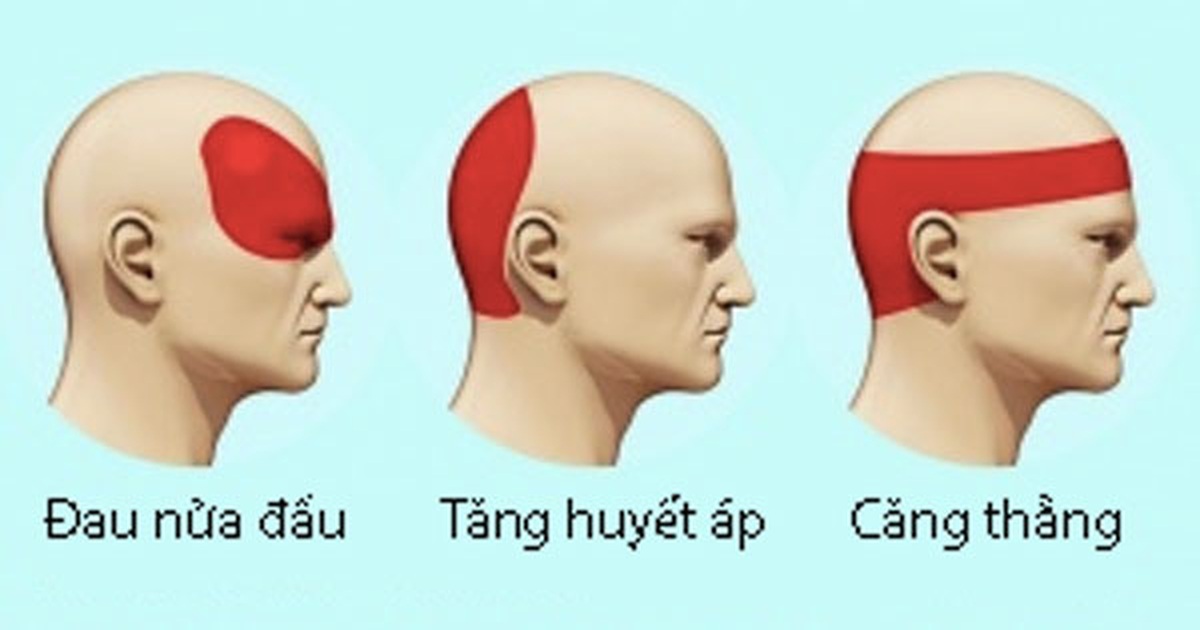 Loại bỏ cơn đau đầu không dùng thuốc trong 5 phút | Báo Dân trí