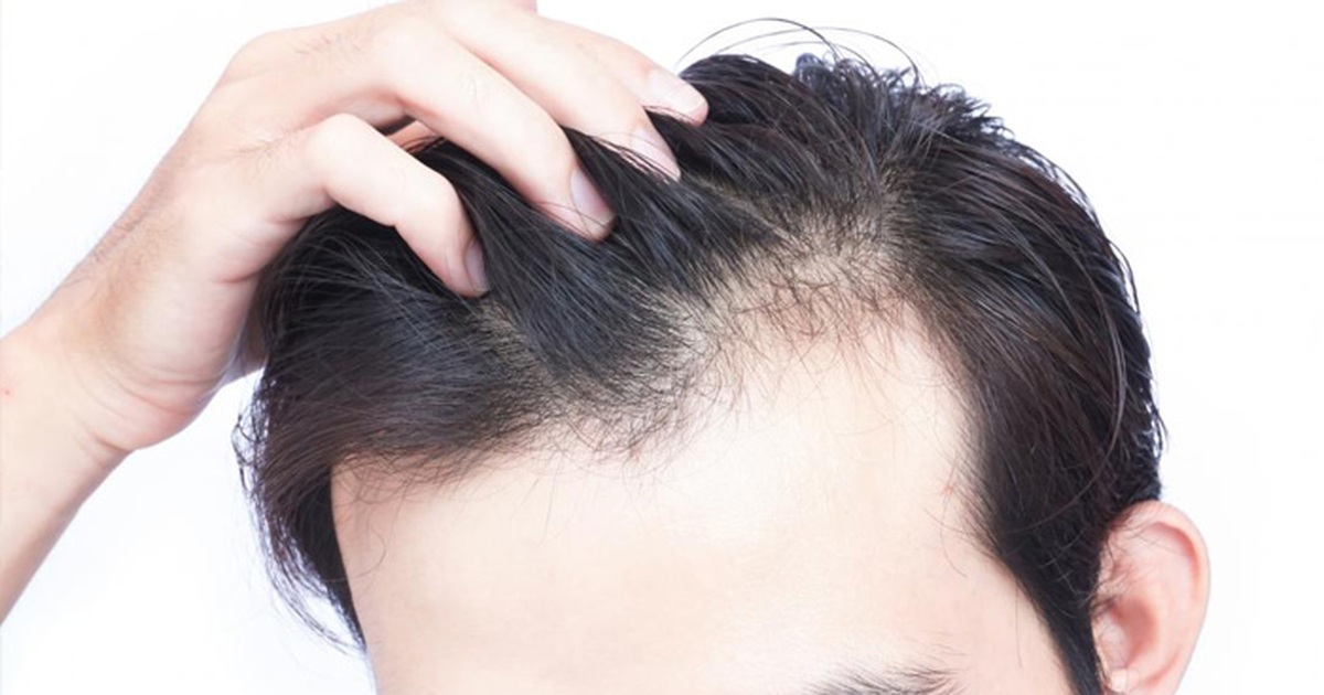 Hơn 100 ảnh về chữa rụng tóc ở nam giới  daotaoneceduvn