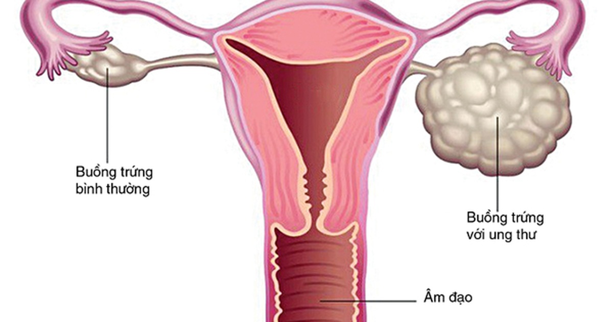 Nhiều trẻ mới hơn 10 tuổi đã bị ung thư buồng trứng | Báo Dân trí