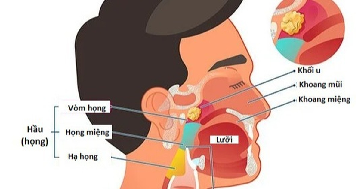 Chẩn đoán ung thư vòm họng bằng cách nào? | Báo Dân trí