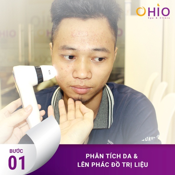 Công nghệ laser acnes giải pháp trị mụn hoàn toàn mới - 2 Công nghệ laser acnes giải pháp trị mụn hoàn toàn mới - 2