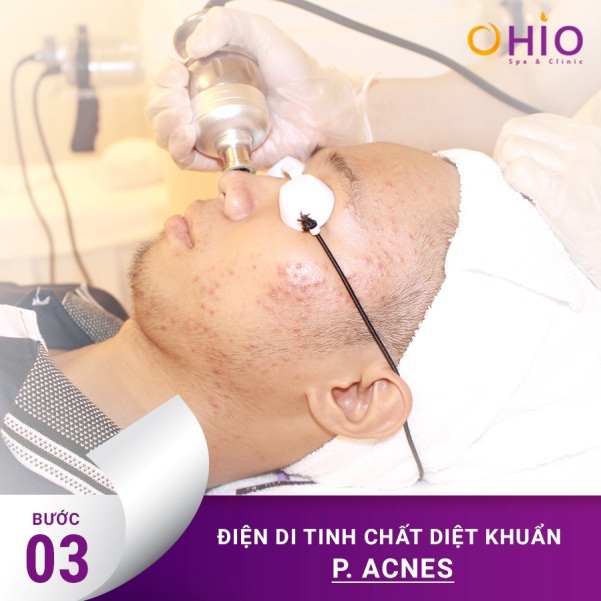 Công nghệ laser acnes giải pháp trị mụn hoàn toàn mới - 3 Quy trình điều trị mụn công nghệ Laser acnes tại Ohio Spa & Clinic