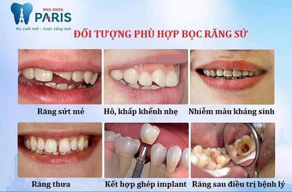 Giới trẻ "mê mẩn" trào lưu bọc răng sứ Nano Shining 5S - 2 Bọc răng sứ Nano Shining 5S khắc phục toàn diện khiếm khuyết răng