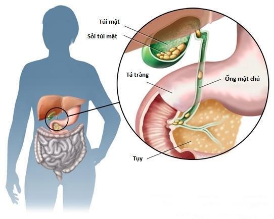 Sỏi mật có những triệu chứng nguy hiểm nào? - Ảnh 1. Sỏi mật có những triệu chứng nguy hiểm nào? - Ảnh 1.