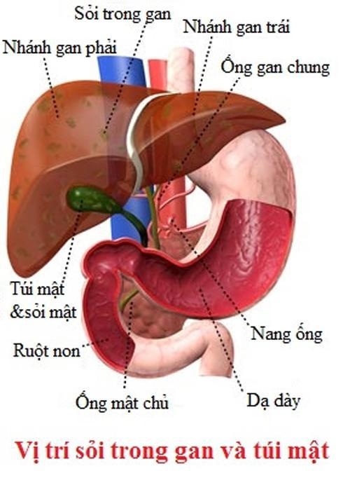 Bị sỏi mật trong gan, tránh chủ quan nếu không muốn phải mổ gan lấy sỏi - 1 Bị sỏi mật trong gan, tránh chủ quan nếu không muốn phải mổ gan lấy sỏi - 1