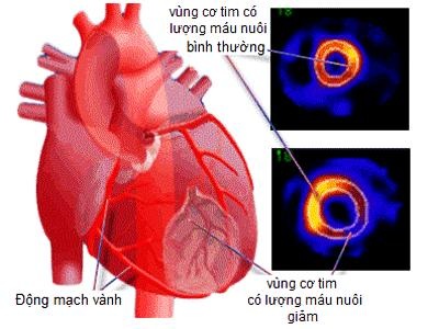 Thiếu máu cơ tim nên ăn gì để giảm đau thắt ngực, tốt cho tim - 1 Thiếu máu cơ tim nên ăn gì để giảm đau thắt ngực, tốt cho tim - 1