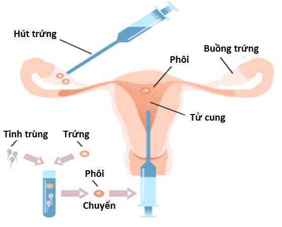 Thêm một giải pháp hỗ trợ sức khỏe sinh sản cho các cặp vợ chồng vô sinh hiếm muộn - Ảnh 3. Thêm một giải pháp hỗ trợ sức khỏe sinh sản cho các cặp vợ chồng vô sinh hiếm muộn - Ảnh 3.