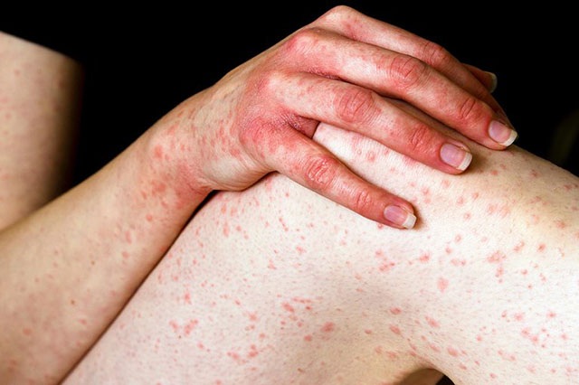 Giải pháp thoát khỏi những cơn ngứa do dị ứng thời tiết - Ảnh 1. Giải pháp thoát khỏi những cơn ngứa do dị ứng thời tiết - Ảnh 1.