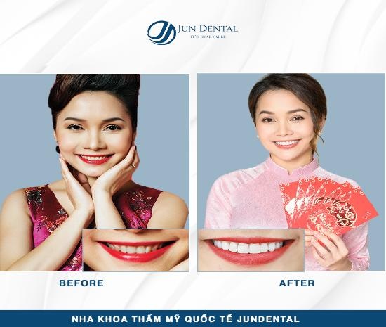 Ưu đãi khủng cuối năm từ Nha khoa Quốc tế Jun Dental - Ảnh 2.