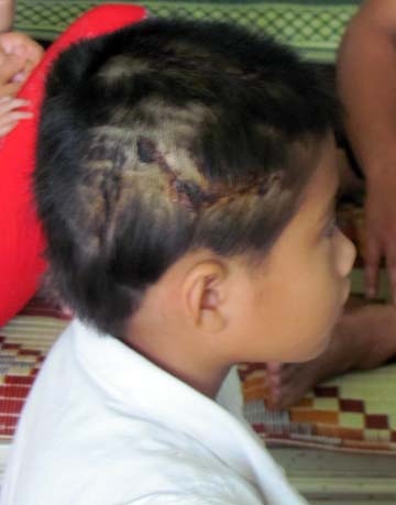 Sức khỏe hai chị em bị bò húc tiến triển tốt - 2 Sức khỏe hai chị em bị bò húc tiến triển tốt - 2