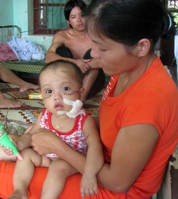 Sức khỏe hai chị em bị bò húc tiến triển tốt - 1 Sức khỏe hai chị em bị bò húc tiến triển tốt - 1