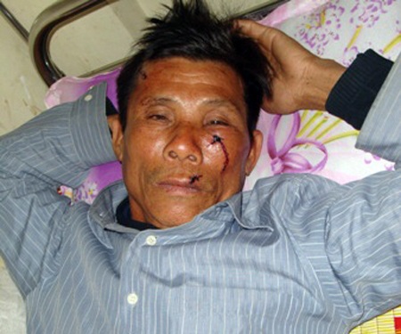 Vừa nhận chức Trưởng thôn đã bị đánh trọng thương - 1