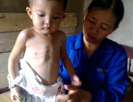 Hơn 40 triệu đồng đến với bé gái 2 tuổi 5 lần mổ tim... hụt