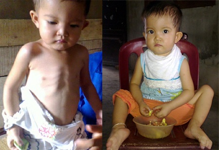 Bé Ngọc Linh ốm yếu trước ca mổ tim (ảnh trái) và có nhiều chuyển biến sau cả mổ