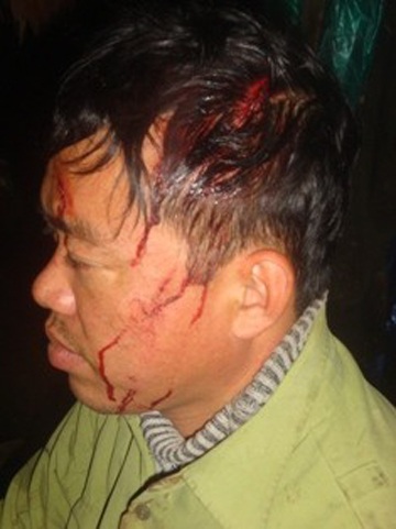 Truy quét lâm tặc giữa đêm, cán bộ khu bảo tồn bị chém trọng thương - 1 Nhân viên Hùng bị chém thương tích ở vùng đầu (ảnh: Giang Nam)