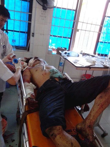 Nạn nhân Thống bị thương nặng, máu chảy nhiều sau vụ nổ