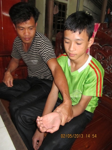 Em Công ngay sau đó được đưa đi bệnh viện để kiểm tra nhưng đến giờ cánh tay em vẫn con tê