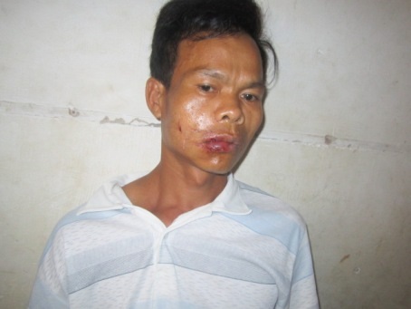 Anh Duẩn bị đánh trọng thương hiện đang được điều trị tại Bệnh viện ĐK Hà Tĩnh