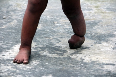 Nhiều đứa trẻ người Chứt tại bản Rào Tre bị tật nguyền do hôn nhân cận huyết gây ra