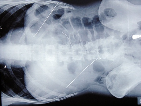 3 thanh kim loại trong ổ bụng bệnh nhân Duẫn lúc chưa mổ