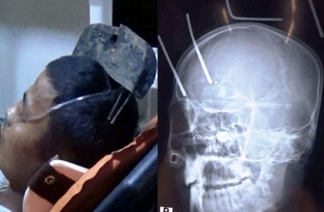 Nạn nhân bị cào sắt găm thẳng vào đầu đã được cứu sống - 1 Nạn nhân bị cào sắt găm thẳng vào đầu đã được cứu sống