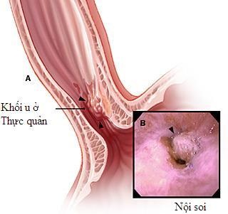Nguy cơ ung thư từ trào ngược kéo dài - 1 Nguy cơ ung thư từ trào ngược kéo dài