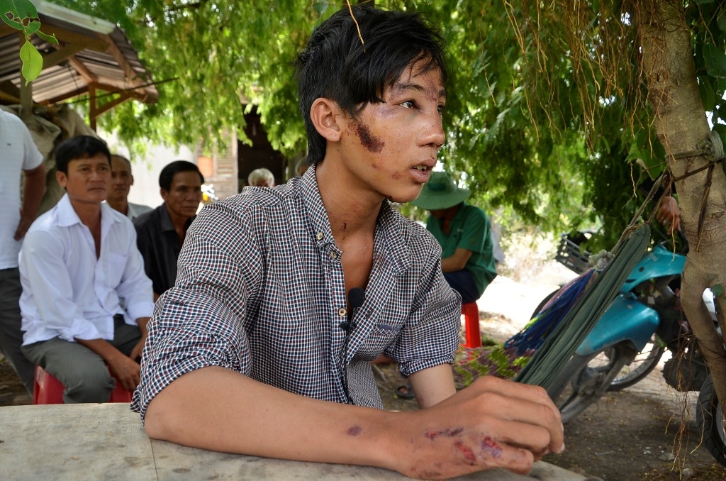 Đào Duy Khánh với nhiều vết thương ở vùng mặt, tay, chân... đang kể lại sự việc với phóng viên