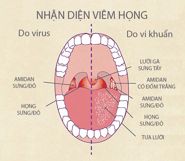 Viêm họng vào mùa, kháng sinh không phải phao cứu sinh! - 1
Phân biệt viêm họng do vi rút với viêm họng do vi khuẩn qua quan sát vòm họng
