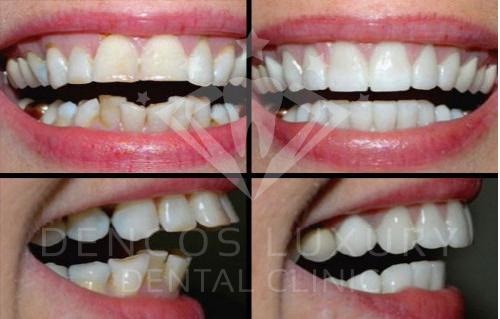 Xu hướng làm đẹp răng nào sẽ gây sốt 2017? - 1
Hàm răng và nụ cười khác biệt sau khi bọc răng sứ 2 in 1