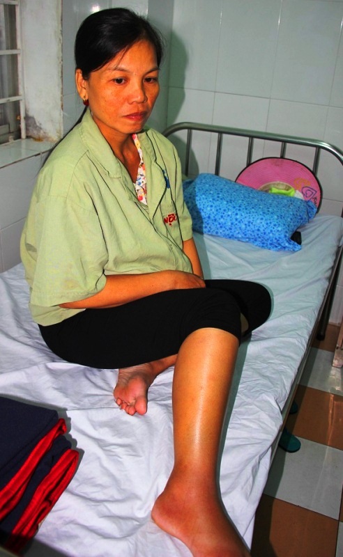 Dân bất an vì nhiều người bị rắn lục đuôi đỏ cắn sau lũ - 1 Chị Phụ bị rắn lục đuôi đỏ căn sau lũ khi cận ngày sinh con