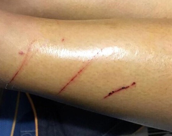 Xác minh thông tin kẻ biến thái rạch đùi nữ sinh tại Hà Nội - 2 Vết thương trên chân của cô gái trẻ. Ảnh: Vũ Hạnh