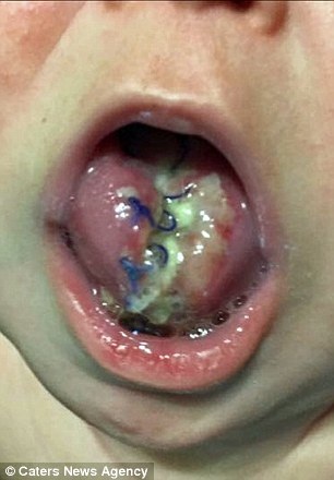 Em bé sơ sinh với chiếc lưỡi khổng lồ đã có thể cười - 3 Em bé sơ sinh với chiếc lưỡi khổng lồ đã có thể cười - 3