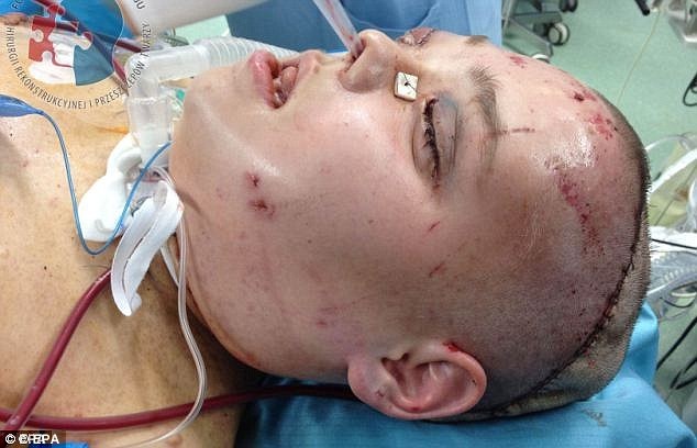 Joanna đã trải qua ca mổ kéo dài 23 tiếng để mang lại cho cô khuôn mặt mới. Các bác sĩ đã thay 80% da mặt của cô