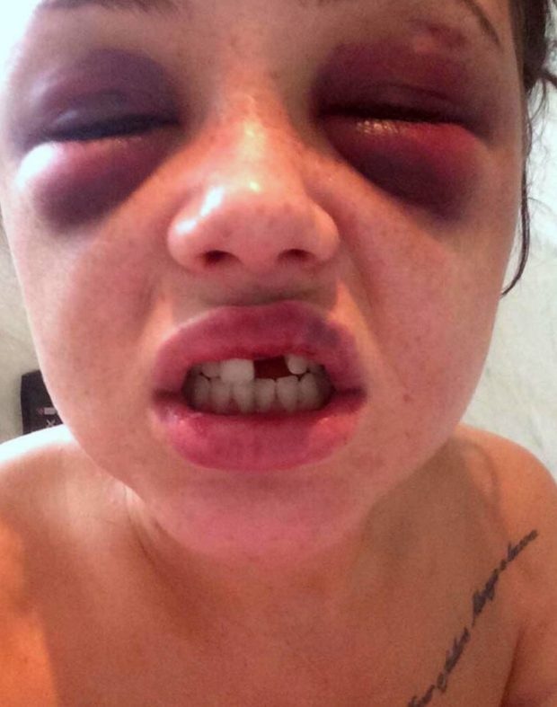 Võ sĩ đánh gãy răng và xương sườn bạn gái vì ghen - 2