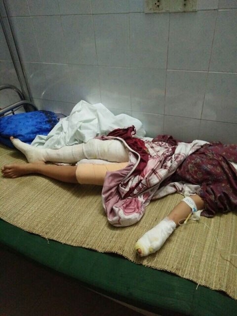 Hà Nội: Cãi vã với hàng xóm, đá văng chảo mỡ khiến 2 cháu bé bỏng nặng - 1 Cháu bé bị bỏng nặng, hiện đang được điều trị tại Viện Bỏng Quốc gia