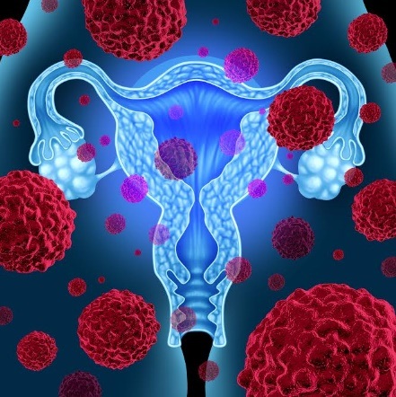 Tiêm vắc xin ngừa HPV vẫn là cách hiệu quả để phòng ngừa ung thư cổ tử cung - 1 Tiêm vắc xin ngừa HPV vẫn là cách hiệu quả để phòng ngừa ung thư cổ tử cung - 1