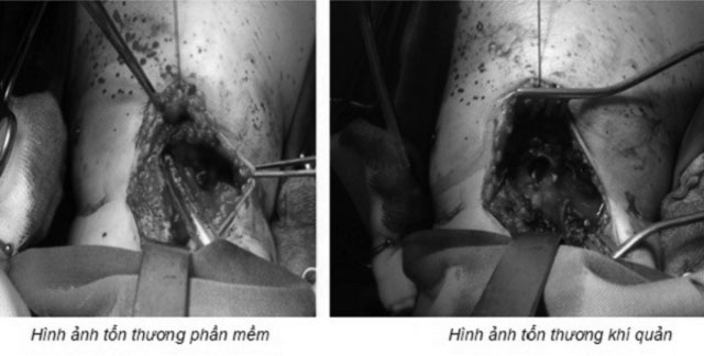 Cứu sống một phụ nữ bị cướp khống chế, cắt đứt khí quản - 1 Cứu sống một phụ nữ bị cướp khống chế, cắt đứt khí quản - 1