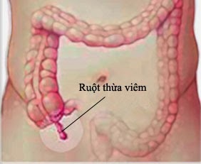 Dấu hiệu viêm ruột thừa? - 1 Dấu hiệu viêm ruột thừa? - 1