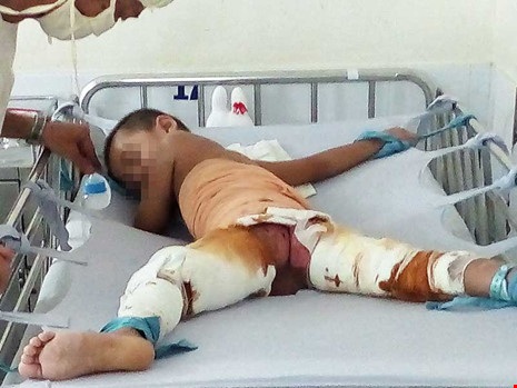 Sơ cứu sai cách, trẻ phỏng nhẹ thành nặng - 1 Bé HVT bị cột chân tay, bị băng bó vì phỏng nước nấu lẩu. Ảnh: TRẦN NGỌC