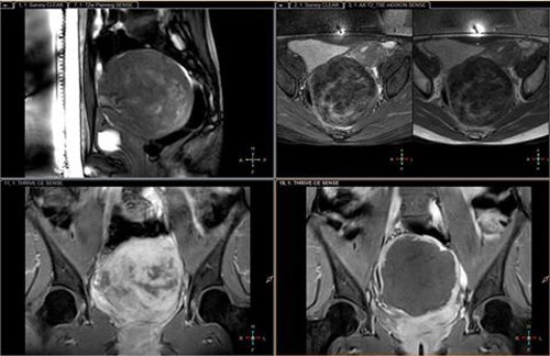 Giảm ham muốn tình dục chỉ vì chủ quan với rối loạn kinh nguyệt - 1 Khối u trên hình ảnh siêu âm.