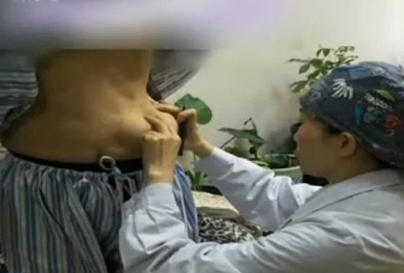 Miếng keo độn ngực trôi tuột xuống bụng sau vài năm phẫu thuật - 1