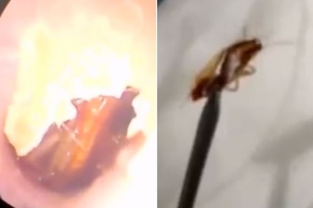 Kinh hãi bác sĩ gắp gián “ngoe nguẩy” khỏi tai người phụ nữ - 1 Con gián bên trong tai (trái) và sau khi được bác sĩ gắp ra ngoài.