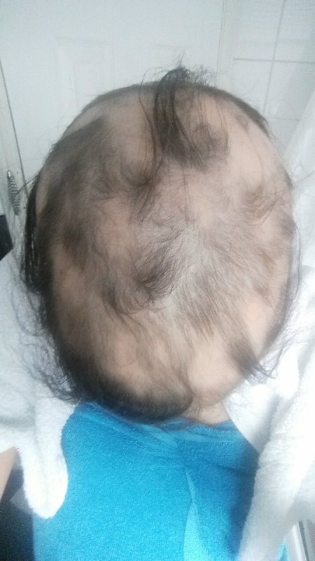 
Ashleigh Alqotaibi bắt đầu rụng tóc từ khi quen bạn trai vào tháng 11/2014
