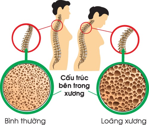 Nguyên nhân gây loãng xương ít người biết - 1 Nguyên nhân gây loãng xương ít người biết - 1