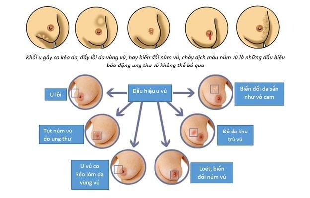 Tự kiểm tra vú - Cơ hội chữa lành ung thư vú - 1 Tự kiểm tra vú - Cơ hội chữa lành ung thư vú - 1