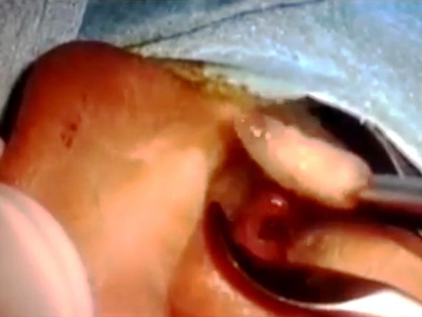 Bác sĩ kinh hoàng gắp ra 14 con dòi trong tai bệnh nhân - 2
Bác sĩ đã lấy ra 14 con giòi trong tai của em