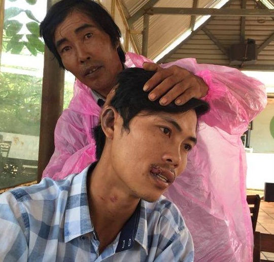 Tố cáo bị đánh bầm dập vì quay clip công an xã chặn xe - 2 Nhiều vết thương ở miệng, tai, cổ của ông Sang