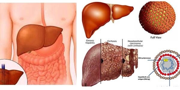 Viêm gan virus B - hiểu đúng để nâng cao chất lượng cuộc sống - 2 Viêm gan virus B - hiểu đúng để nâng cao chất lượng cuộc sống - 2