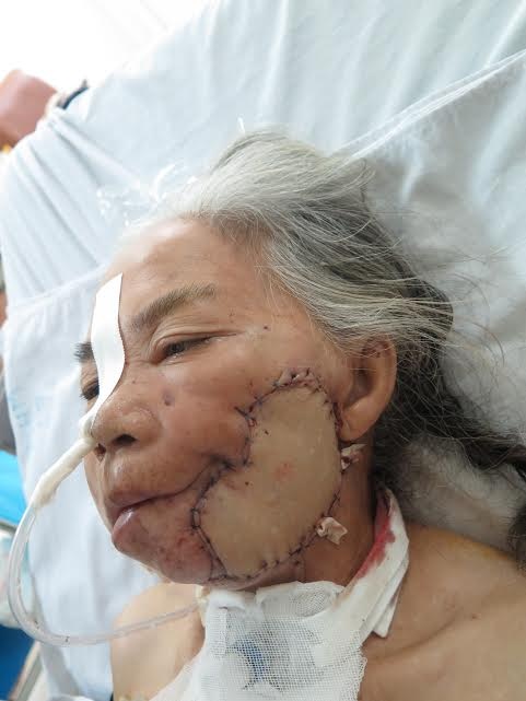 Cụ G sau phẫu thuật.