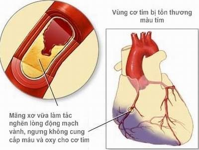 Mỡ máu dẫn tới nhiều bệnh lý nguy hiểm.